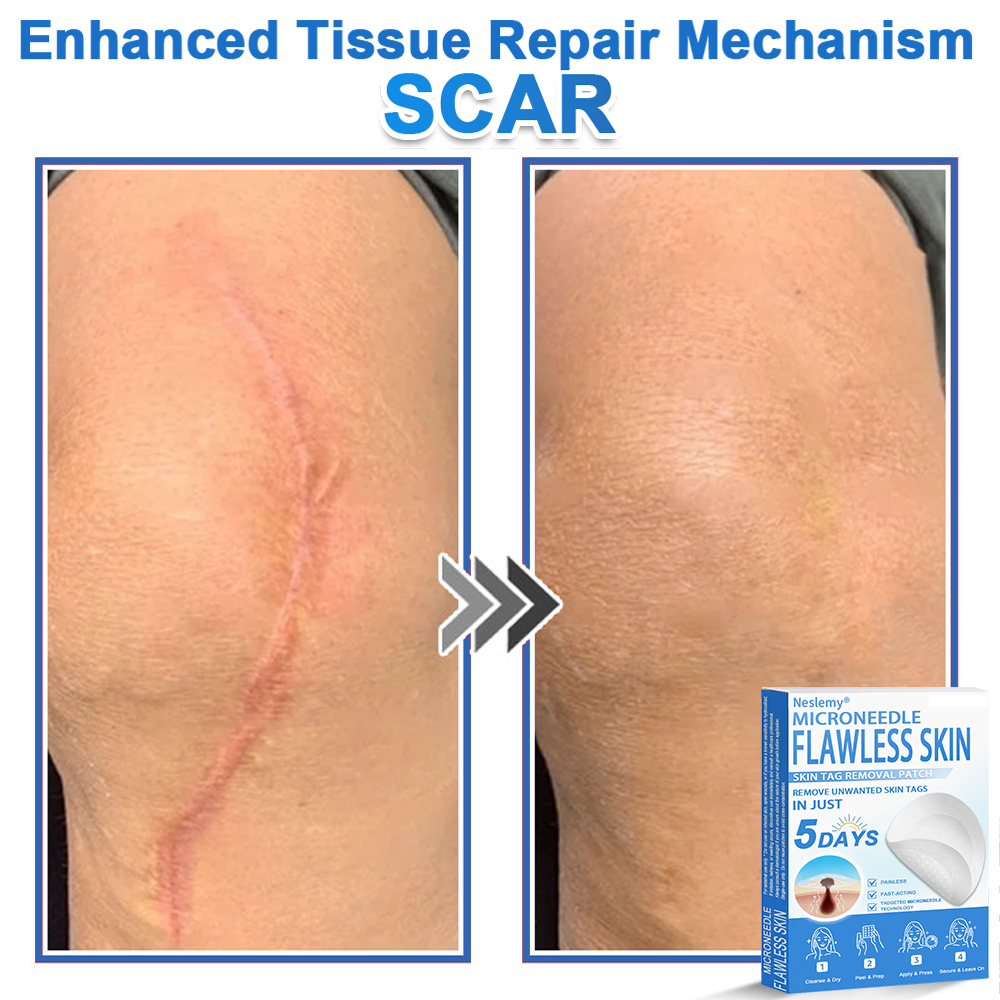 🔥Last Day 80% OFF 👨⚕️ Bellevery® 2-in-1 Microneedle & Hydrocolloid Patch | Raised Moles,Acne, Flat Warts & Skin Tags Remover | Improves Wrinkles, Scars & Blemishes | Invisible Pimple Patches for Face & Body