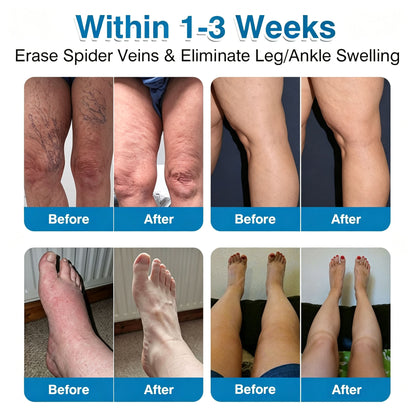 🏆✅️🏃Windyra® VeinRepair Microneedle Patch Roll⚡Instant Relief, Long-Term Results
