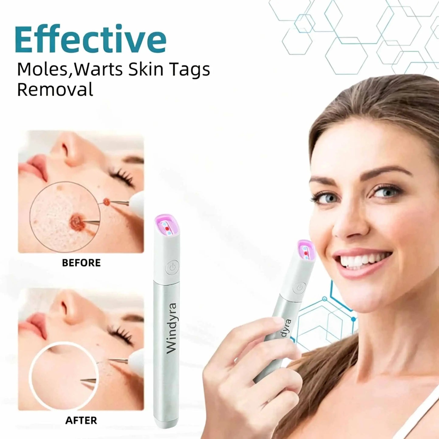 Windyra™ All-in-One CO₂ Laser Eraser Pen | Removes Moles, Warts, Skin Flaws & Pigmentation