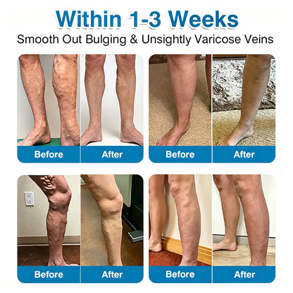 🏆✅️🏃Windyra® VeinRepair Microneedle Patch Roll⚡Instant Relief, Long-Term Results