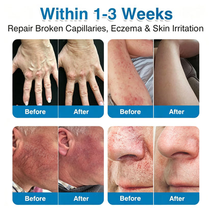 🏆✅️🏃Windyra® VeinRepair Microneedle Patch Roll⚡Instant Relief, Long-Term Results