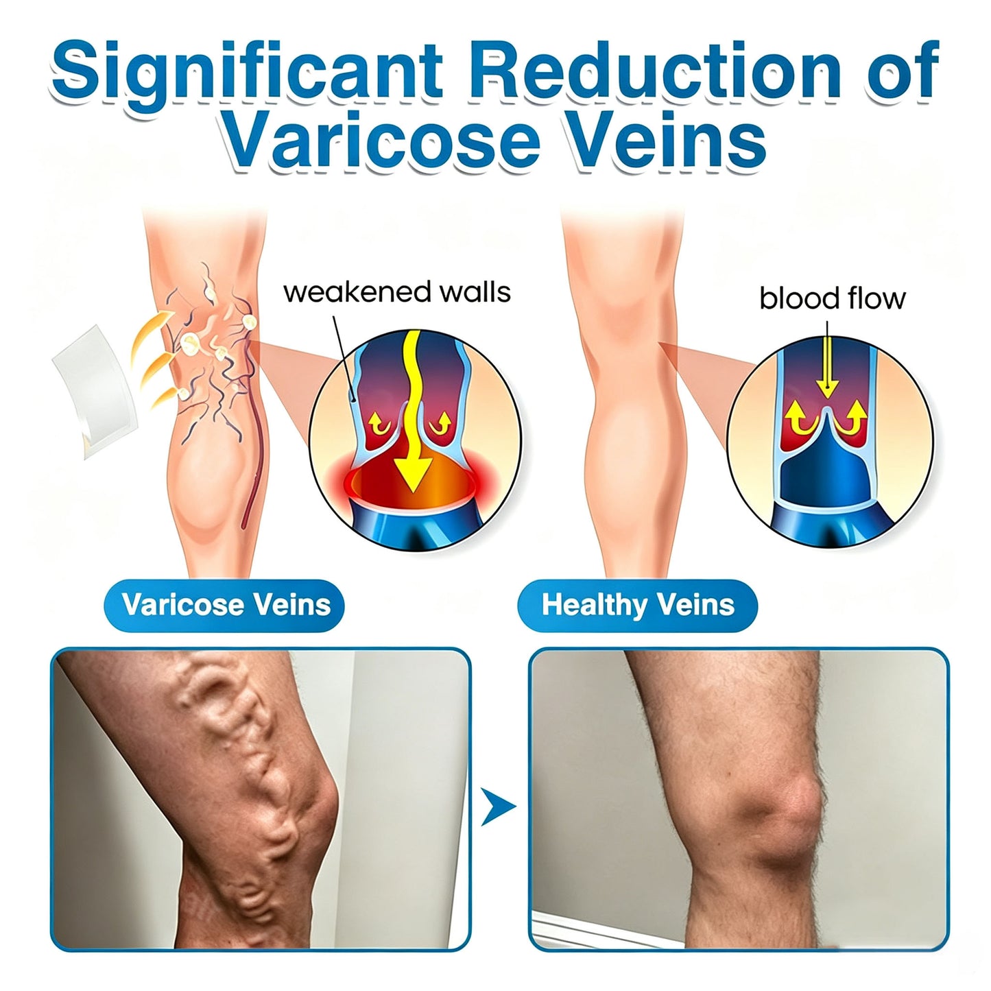 🏆✅️🏃Windyra® VeinRepair Microneedle Patch Roll⚡Instant Relief, Long-Term Results