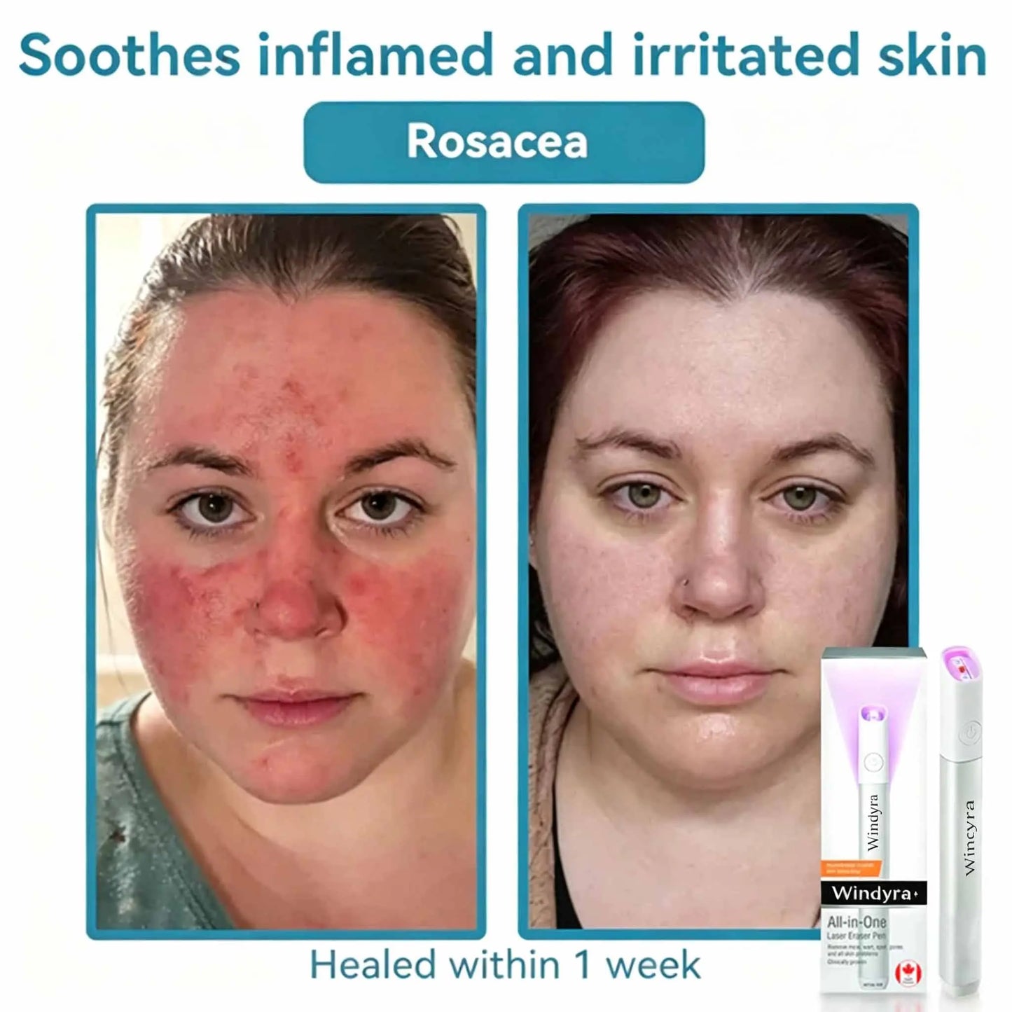 Windyra™ All-in-One CO₂ Laser Eraser Pen | Removes Moles, Warts, Skin Flaws & Pigmentation