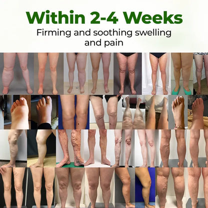Windyra® Professional Leg Circulation Cream