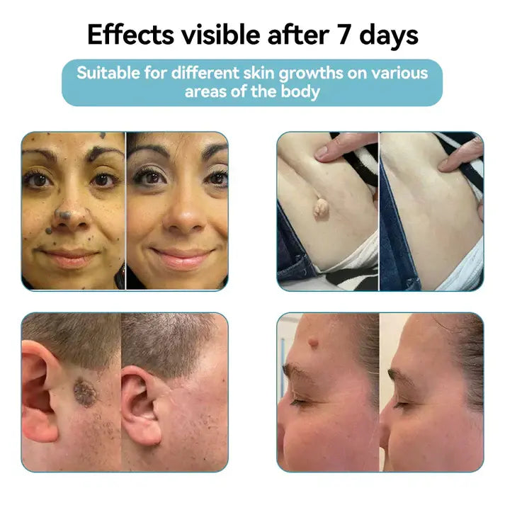 Windyra™ All-in-One CO₂ Laser Eraser Pen | Removes Moles, Warts, Skin Flaws & Pigmentation