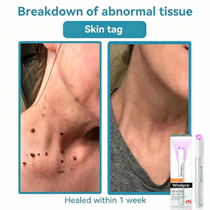 Windyra™ All-in-One CO₂ Laser Eraser Pen | Removes Moles, Warts, Skin Flaws & Pigmentation