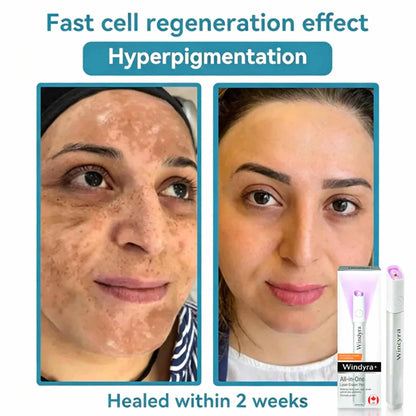 Windyra™ All-in-One CO₂ Laser Eraser Pen | Removes Moles, Warts, Skin Flaws & Pigmentation