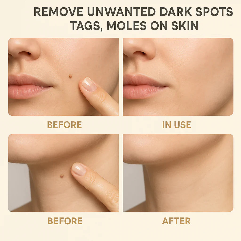 🔥LAST DAY Buy 2 Get 1 Free Windyra™️ Organic Skin Tag Remover Serum | All Natural For Warts