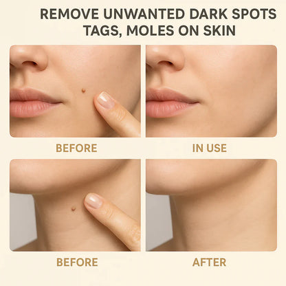 🔥LAST DAY Buy 2 Get 1 Free Windyra™️ Organic Skin Tag Remover Serum | All Natural For Warts