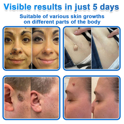 🔥Last Day 80% OFF 👨‍⚕️  Bellevery® 2-in-1 Microneedle & Hydrocolloid Patch | Raised Moles,Acne,  Flat Warts & Skin Tags Remover | Improves Wrinkles, Scars & Blemishes | Invisible Pimple Patches for Face & Body