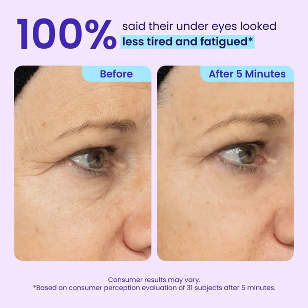 🔥Last Day 80% OFF-Windyra® Eye Bag Instant Eraser, Tightens, Firms, & Blurs Wrinkles