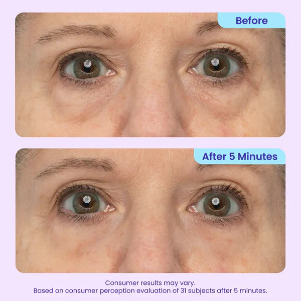 🔥Last Day 80% OFF-Windyra® Eye Bag Instant Eraser, Tightens, Firms, & Blurs Wrinkles