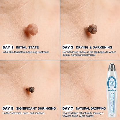 Windyra® 7-𝐷𝑎𝑦 𝗧𝐚𝐠 & 𝗦𝗽𝐨𝐭 𝐄𝐫𝒂𝒔𝒆𝒓(Zero Pain, Zero 𝐒𝐜𝐚𝒓𝒔 Rollerball)