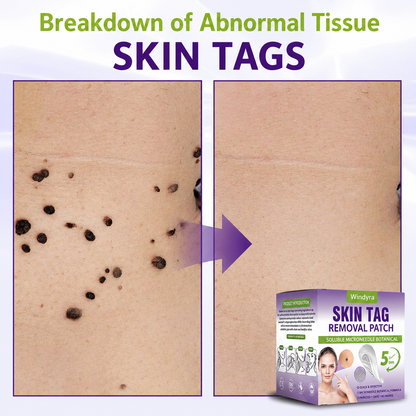 Windyra® Soluble Microneedle Botanical Skin Tag Removal Patch
