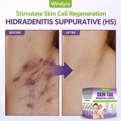 Windyra® Soluble Microneedle Botanical Skin Tag Removal Patch