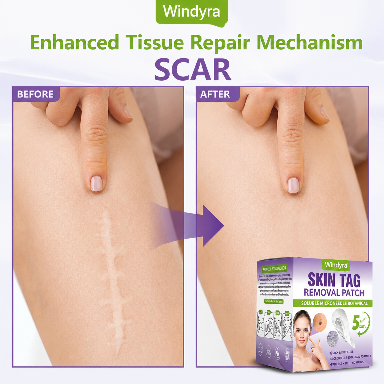 Windyra® Soluble Microneedle Botanical Skin Tag Removal Patch