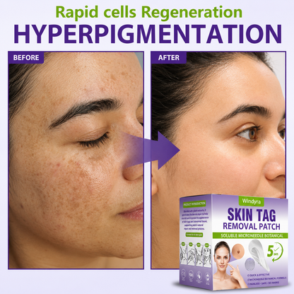 Windyra® Soluble Microneedle Botanical Skin Tag Removal Patch