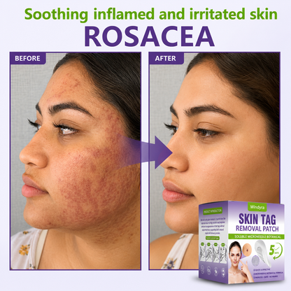 Windyra® Soluble Microneedle Botanical Skin Tag Removal Patch