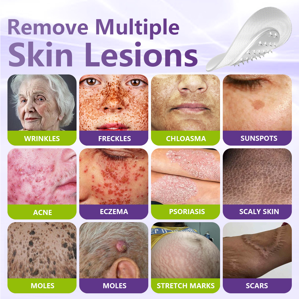 Windyra® Soluble Microneedle Botanical Skin Tag Removal Patch