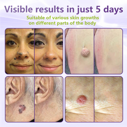 Windyra® Soluble Microneedle Botanical Skin Tag Removal Patch